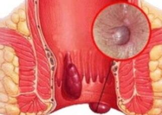 How are hemorrhoids